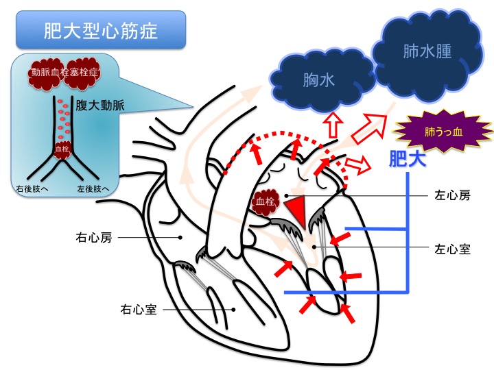 肥大型心筋症