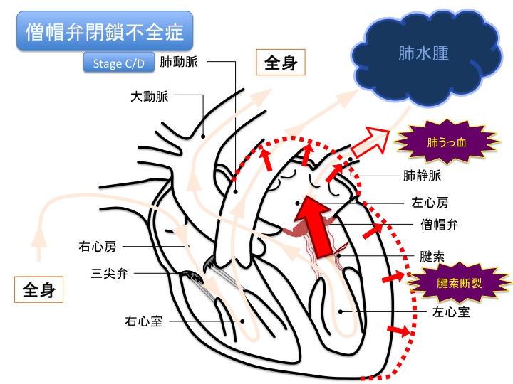 僧帽弁閉鎖不全症