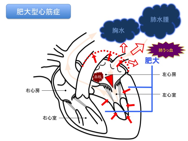 肥大型心筋症