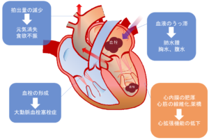 拘束型心筋症