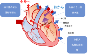 僧帽弁閉鎖不全症の症状