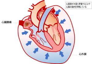心臓腫瘍