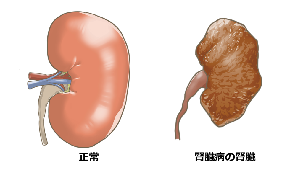 正常な腎臓と、腎臓病の腎臓