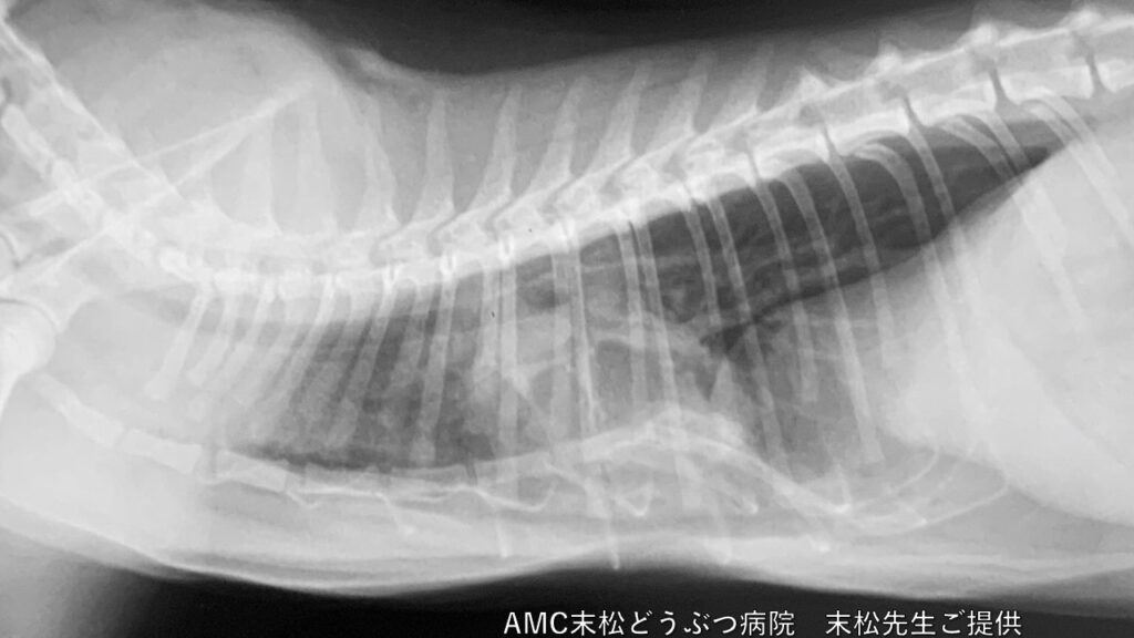 陰圧性漏斗胸のX線写真