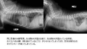 胸水が溜まる前と溜まった後