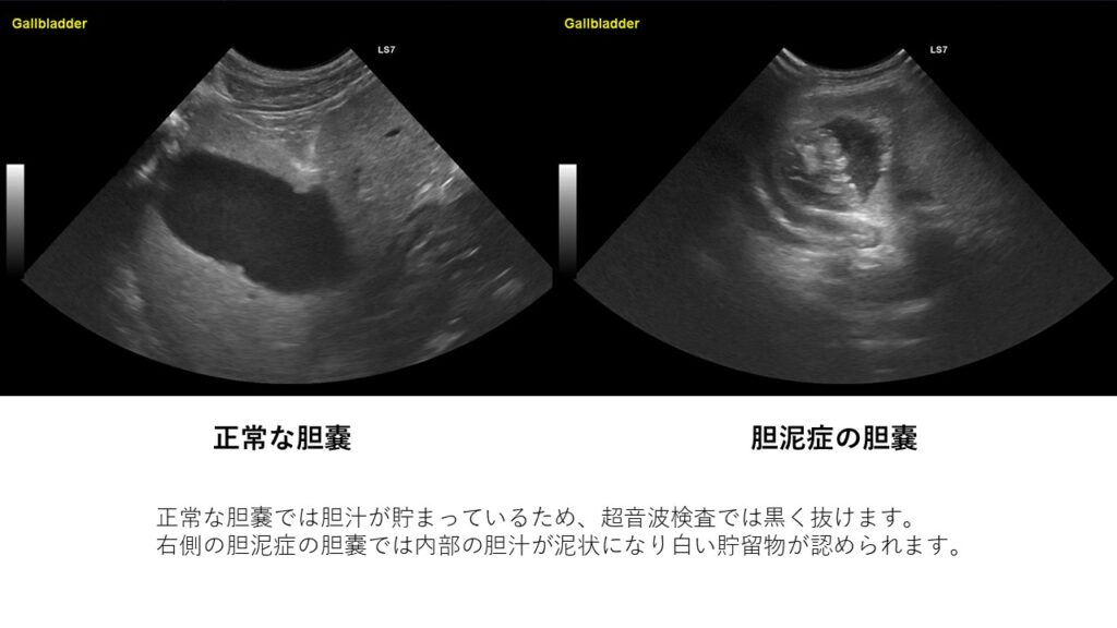 正常な胆嚢と胆泥症の胆嚢のエコー