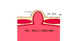 ヘルニアの症状