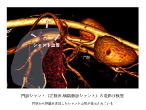 門脈シャントの造営CT