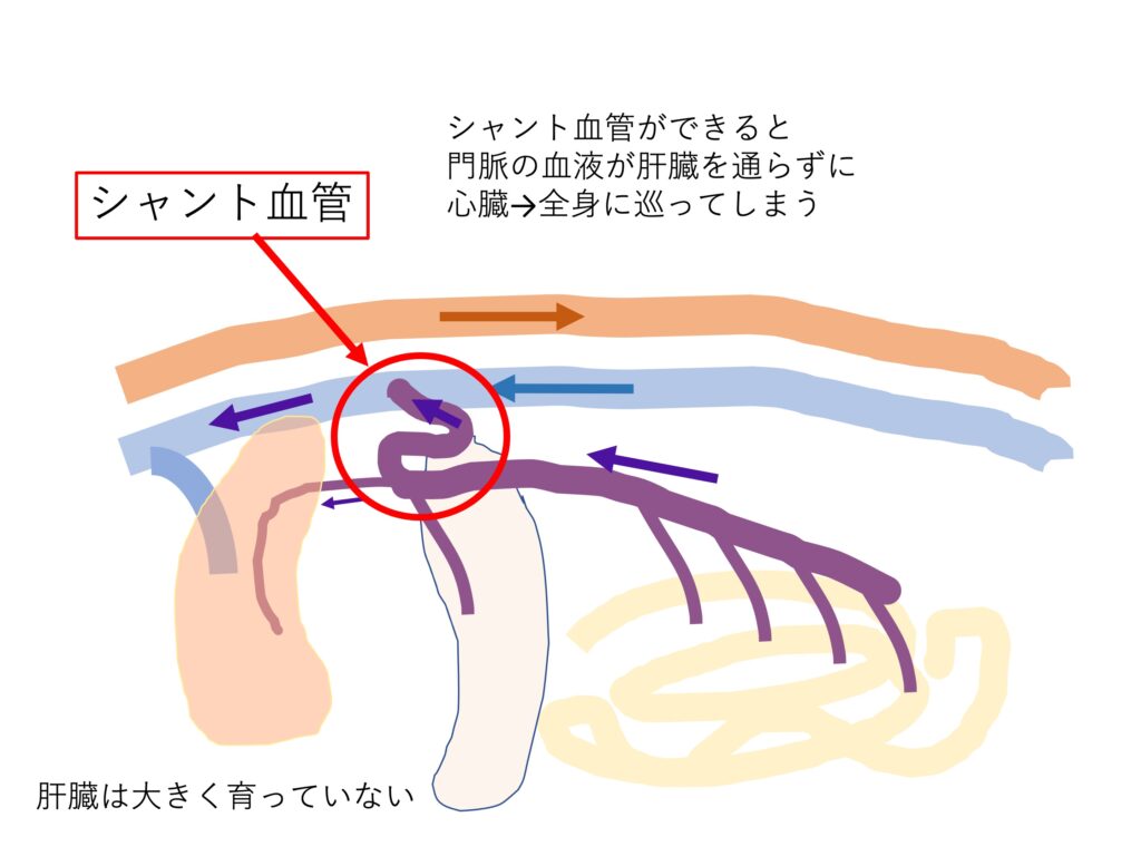 シャント血管