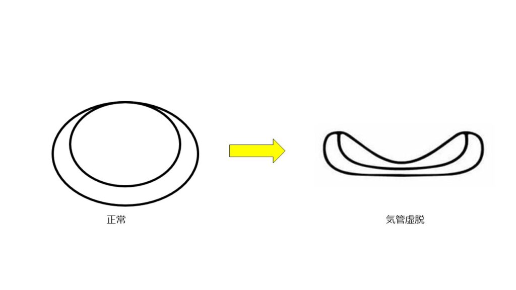 正常な膜性壁と気管虚脱の膜性壁