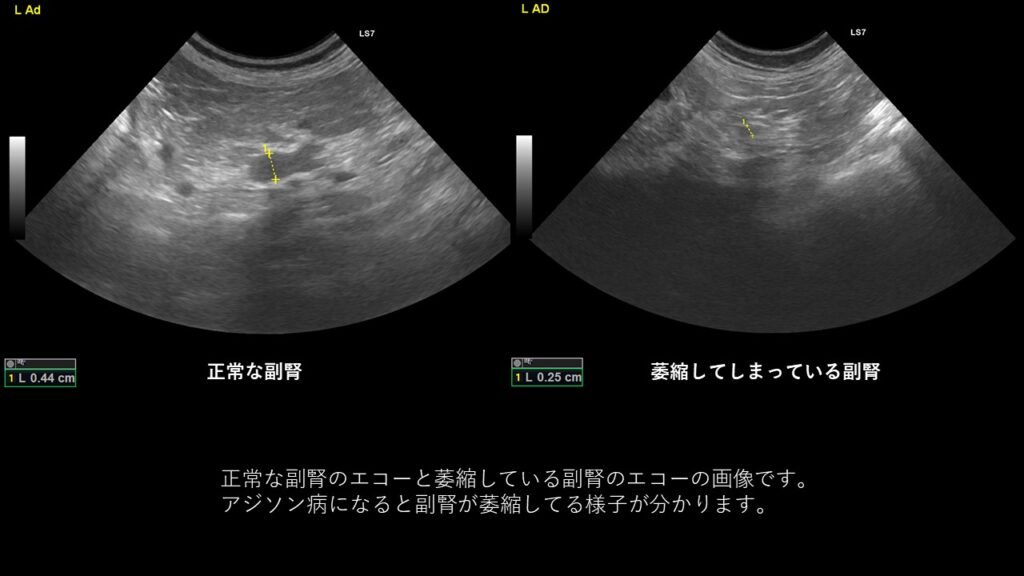 正常な副腎と、萎縮してしまっている副腎のエコー画像