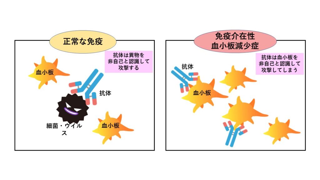正常な免疫と免疫介在性血小板減少病