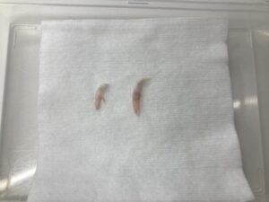 遺残していた乳歯の除去