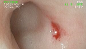 腸管出血