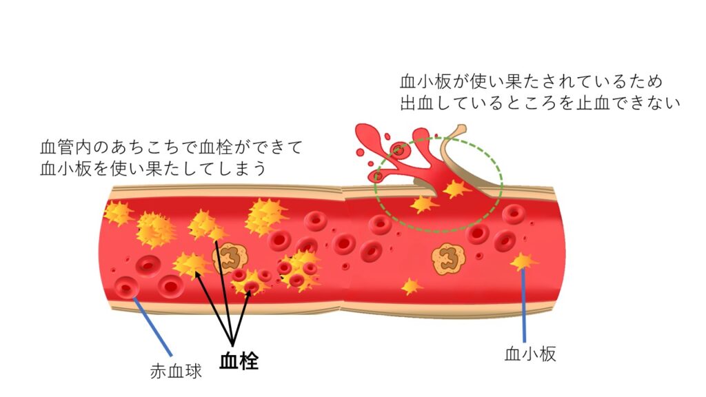血管と血栓のイラスト