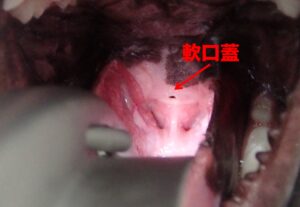 軟口蓋切除手術前の写真