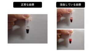 正常な血漿と溶血している血漿の比較