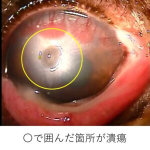 角膜潰瘍