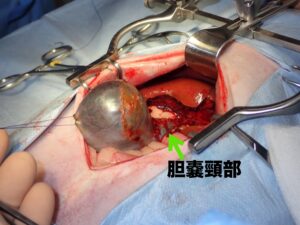 胆嚢頸から胆嚢管までの露出